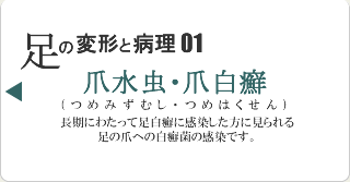 爪水虫・爪白癬