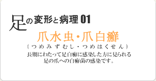 爪水虫・爪白癬