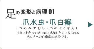 爪水虫(爪白癬)