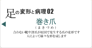 巻き爪