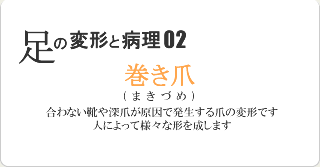 巻き爪