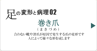 巻き爪