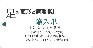 陥入爪