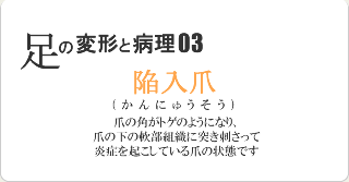 陥入爪