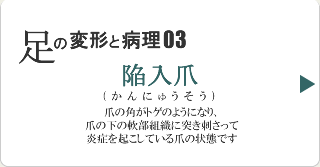 陥入爪