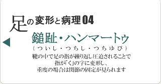 鎚趾・ハンマートゥ