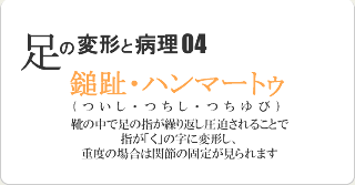 鎚趾・ハンマートゥ