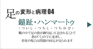 鎚趾・ハンマートゥ