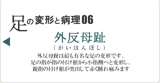 外反母趾