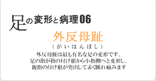 外反母趾