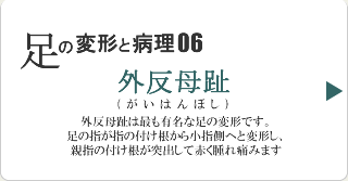 外反母趾