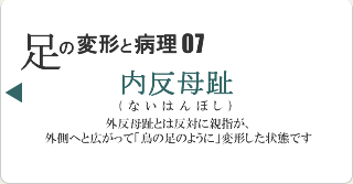 内反母趾