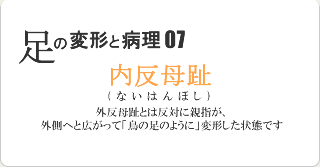 内反母趾