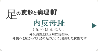 内反母趾