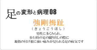 強剛拇趾