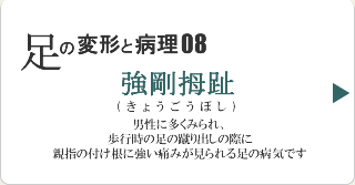 強剛拇趾
