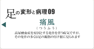 痛風
