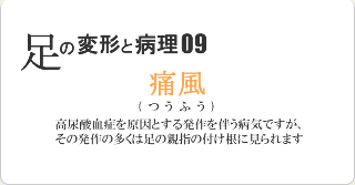 痛風