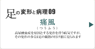 痛風