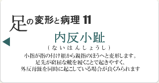 内反小趾