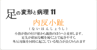 内反小趾