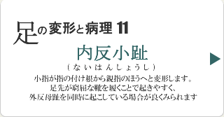 内反小趾
