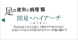凹足・ハイアーチ