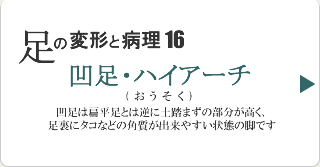 凹足