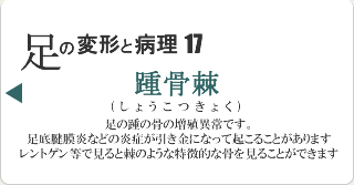 踵骨棘