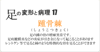 踵骨棘