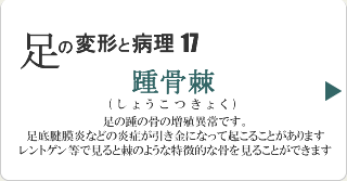 踵骨棘