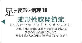 変形性膝関節症