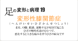 変形性膝関節症