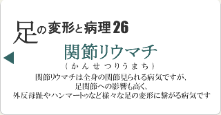 関節リウマチ