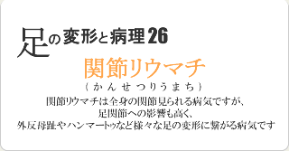 関節リウマチ