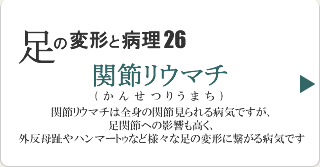 関節リウマチ