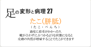 たこ(胼胝)